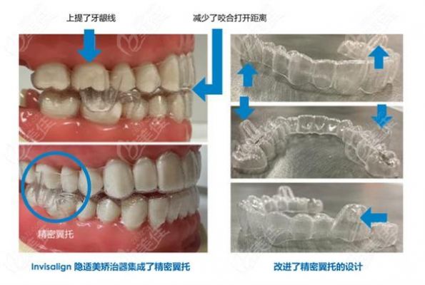 什么是前托（前拓是什么意思）-图1