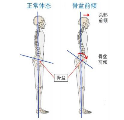 什么是骨岔（什么是骨盆前倾）-图2