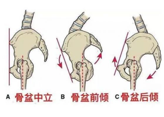 什么是骨岔（什么是骨盆前倾）-图3